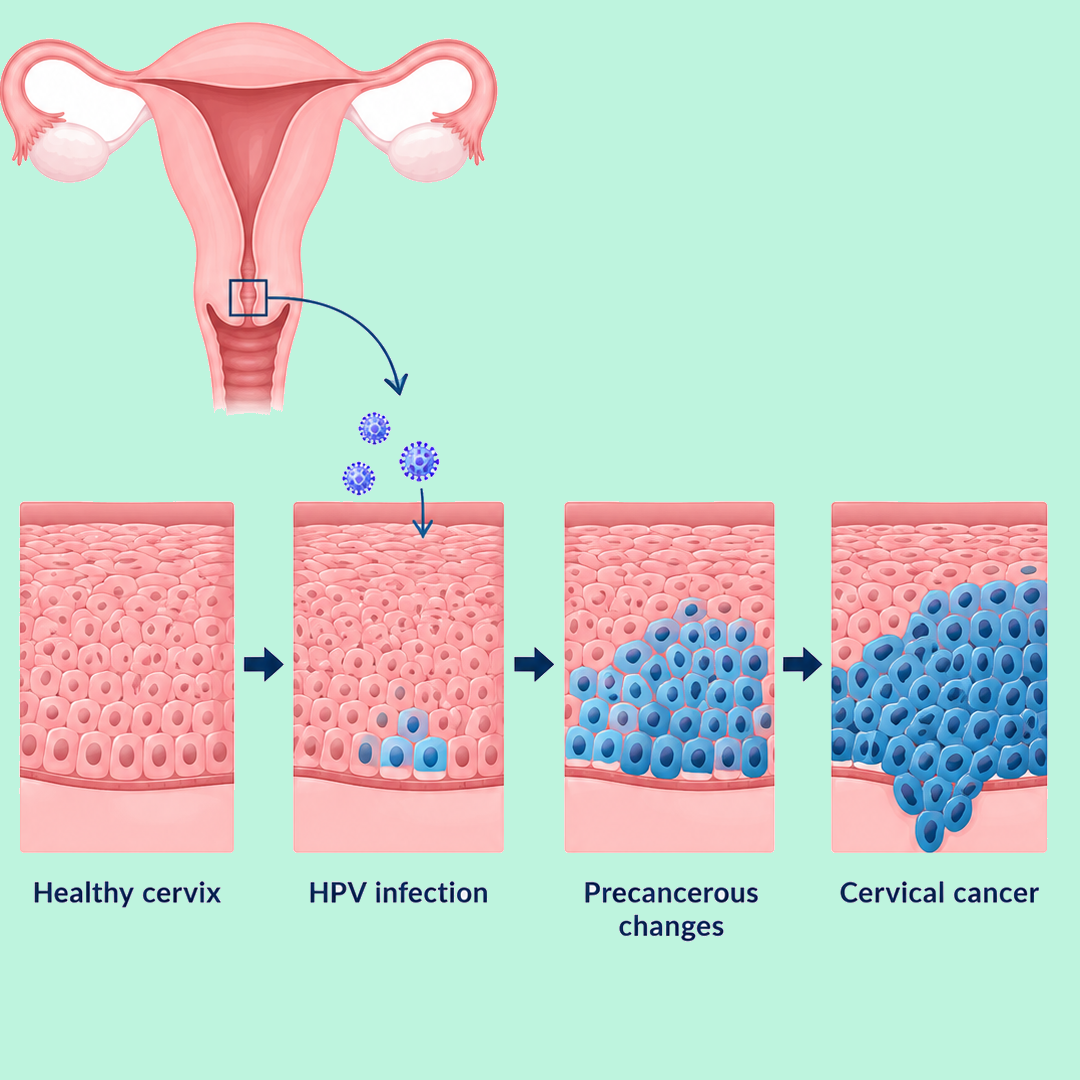 hpv and cervical cancer